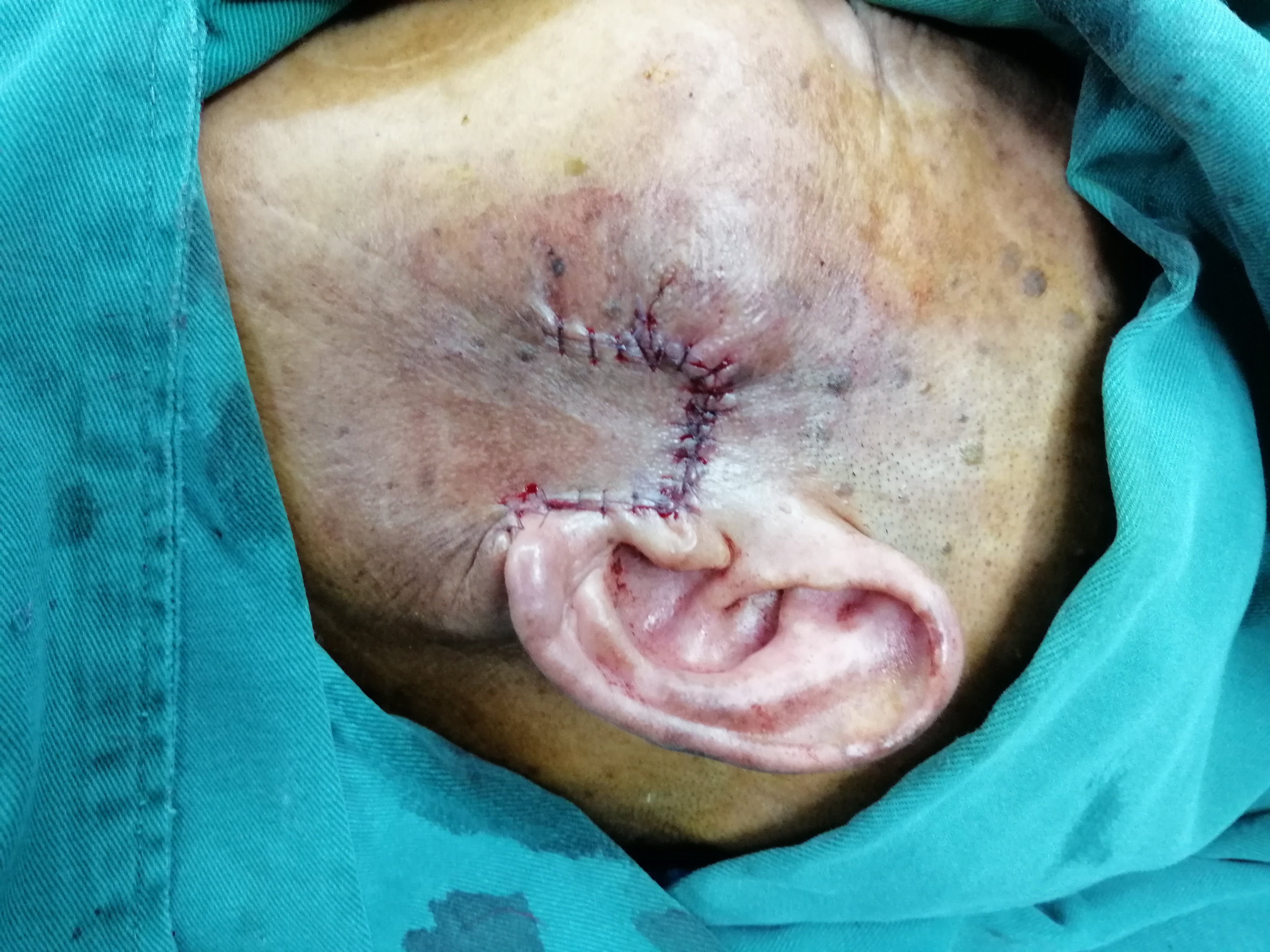 老人脸上出现肉疙瘩,脸上有个硬疙瘩手术切除