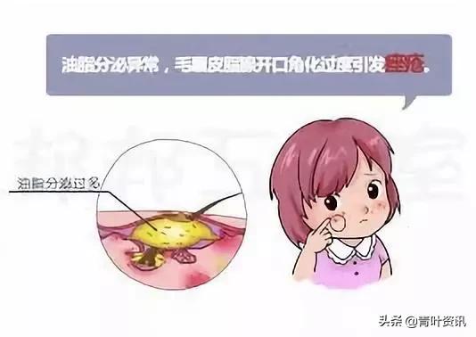 孕期长痘痘该怎么办,孕期长痘痘又不能乱用药该怎么治