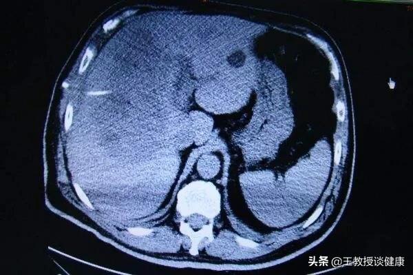 肛周脓肿是不是糖尿病引起的,脓肿为什么会有硬结