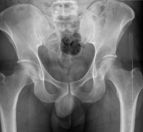 老年人摔到大胯怎么办,老人摔到胯骨多久死