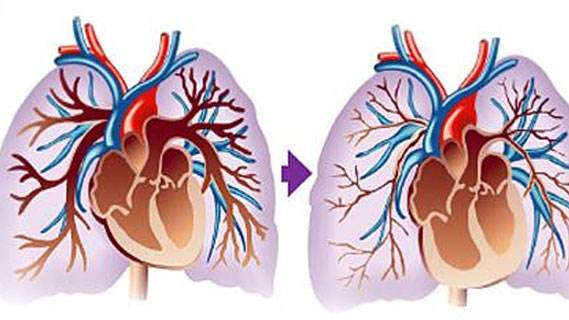 儿童肺动脉高压万艾可,伟哥为什么可以治疗肺动脉高压