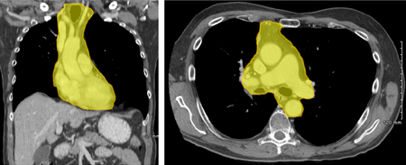 纵隔解剖3d,纵隔窗影像解剖图示