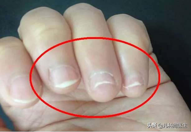 大人缺铁缺钙缺锌怎么办,孩子缺钙又缺铁怎么补