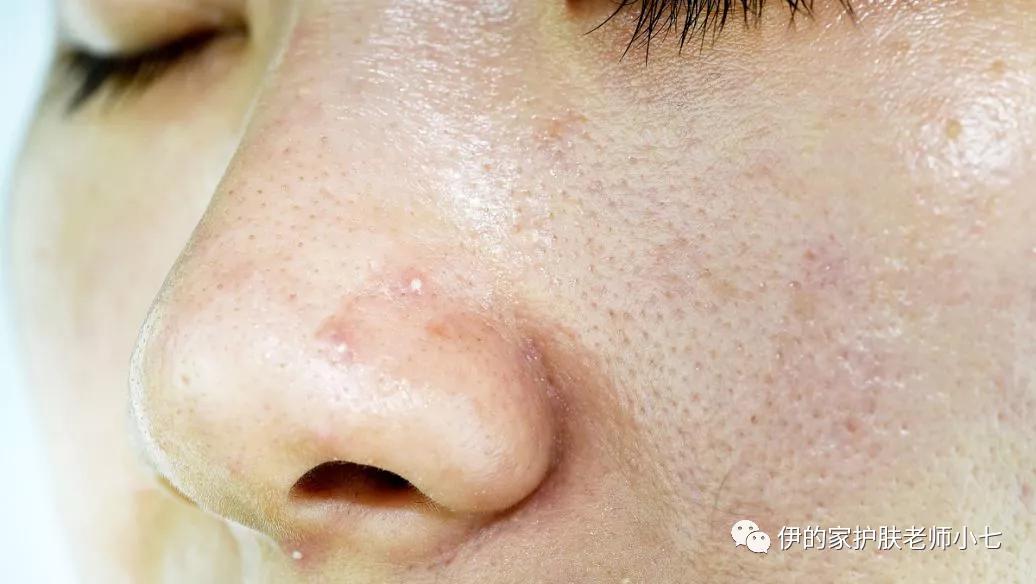 额头后背长痘痘是什么原因,额头长痘痘的原因和解决方法