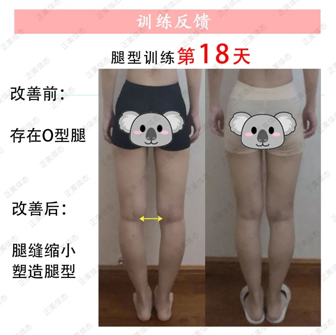 o型腿怎么走路有助于变直,成人o型腿最快变直的方法