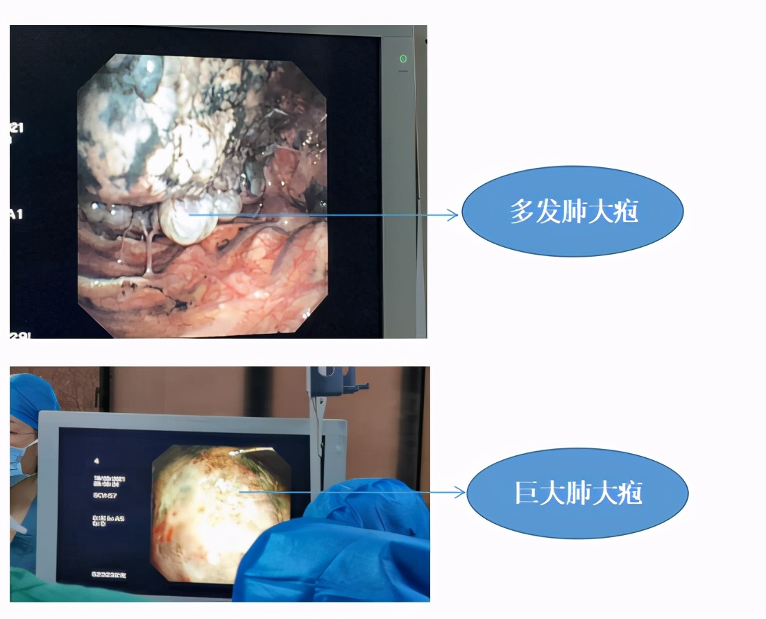 中国第一例肺移植病人,哪个医院能肺移植