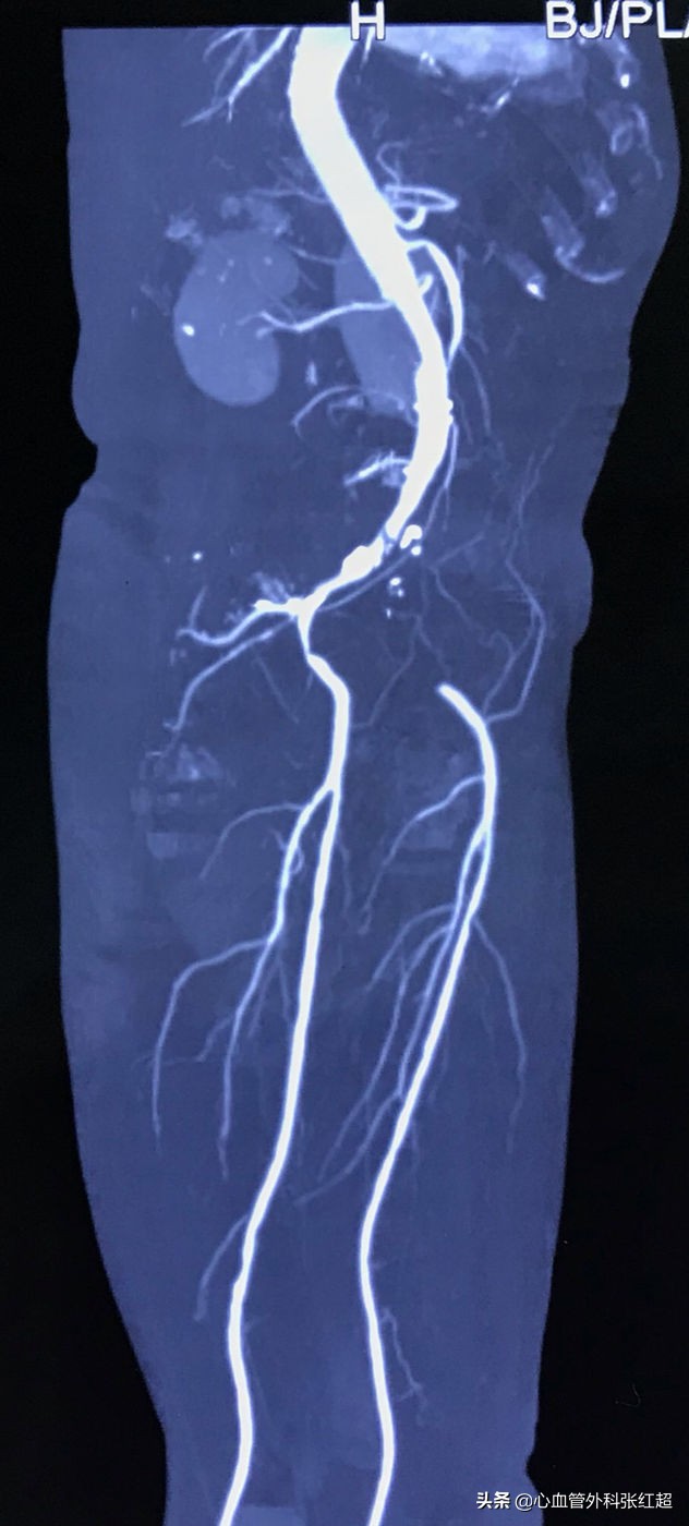 外周血管外科治疗范围,外周血管介入治疗疗程