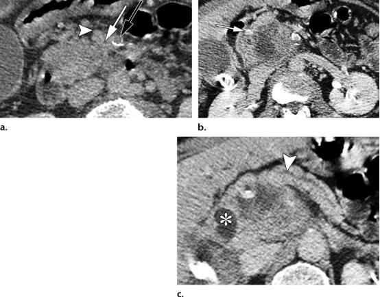 急性胰腺炎和慢性胰腺有什么症状,胰腺炎合并胰腺肿物