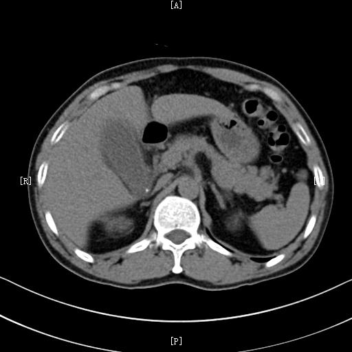 中右上腹疼痛有哪些病因,右上腹反复隐痛却查不出病因