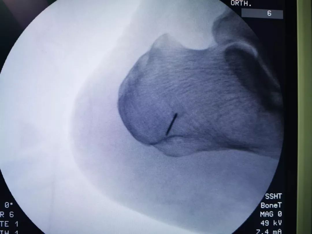 广州天河区中医院骨伤二科成功实施关节镜下跟骨骨刺摘除术