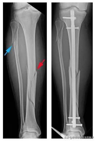 小腿腓骨骨折保守治疗多久能走路,小腿骨折保守治疗多久能恢复正常