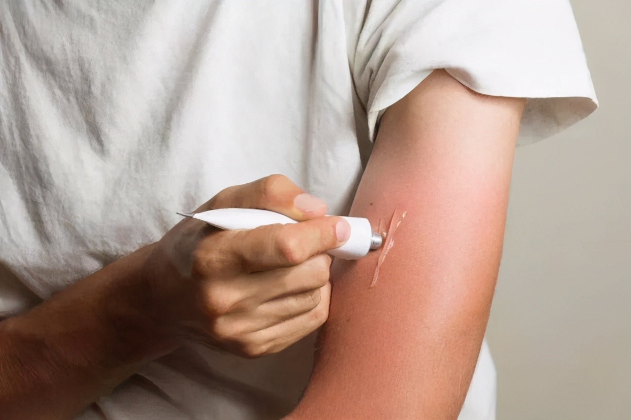 孩子被咬后，若呈现这些状况代表不是蚊子咬的包，别自行处理