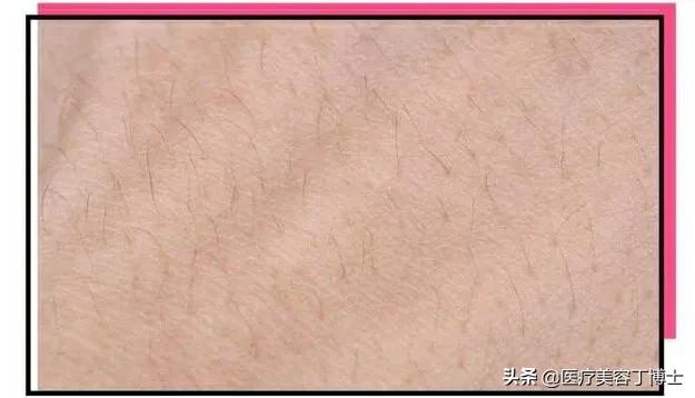 毛孔粗大皮肤又干是什么肤质,毛孔粗大的克星怎么解决