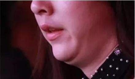 娃娃脸婴儿肥怎么瘦,怎么区分双下巴和婴儿肥