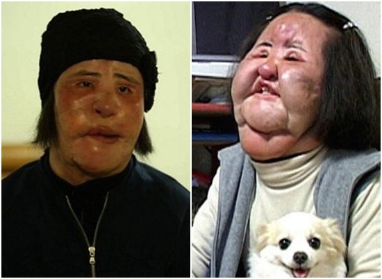 韩慧景整容事件原因,韩慧景是怎么整容失败的