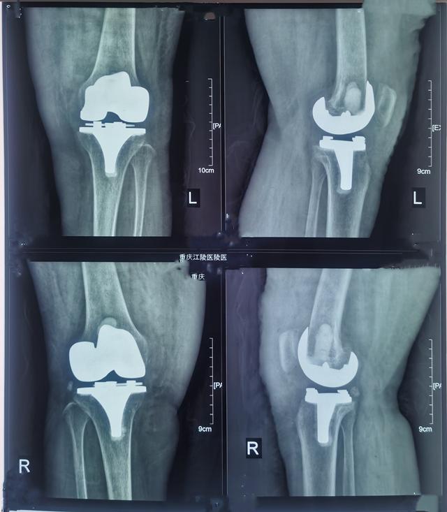膝盖关节炎疼痛近十年,双膝骨性关节炎保守治疗方法