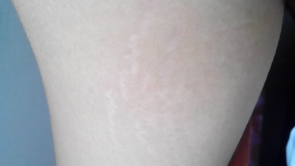 肥胖纹妊娠纹还有什么纹,肥胖纹或者生长纹怎么消除