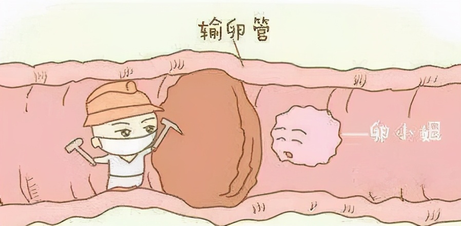 输卵管堵塞是什么原因造成的,输卵管堵塞可以做人工授精吗