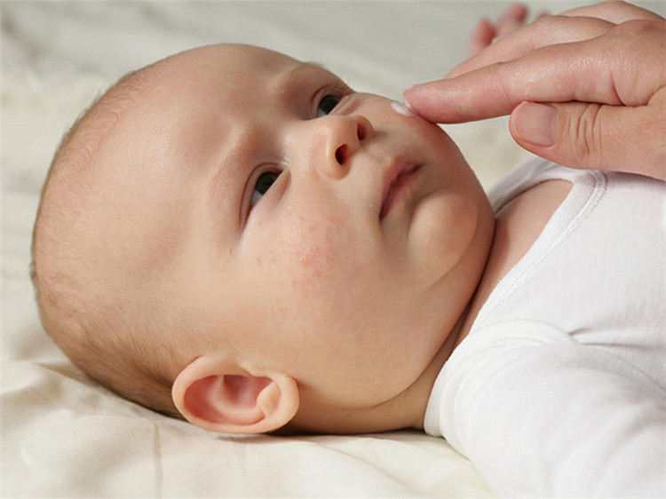秋冬季节小儿湿疹怎么办,季节性湿疹注意什么