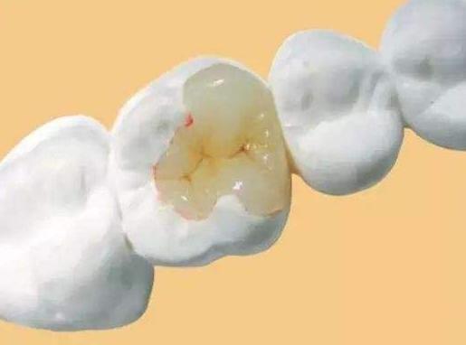 同样是补牙，为什么差距那么大？不同的补牙材料到底该怎么选？