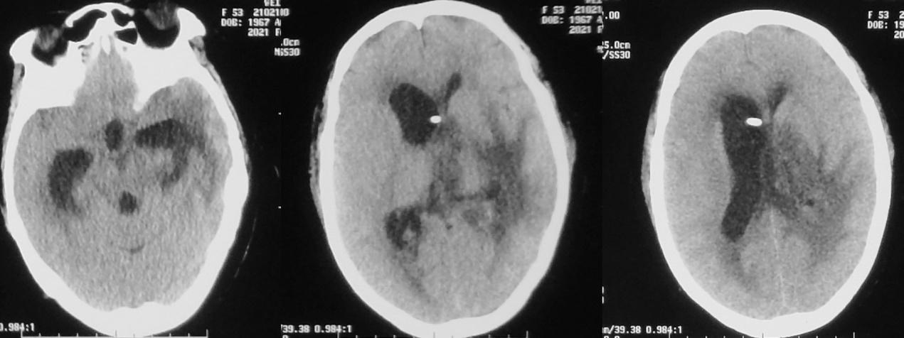 脑脓肿合并脑膜炎需要手术吗,脑脓肿进入左侧脑室严重吗