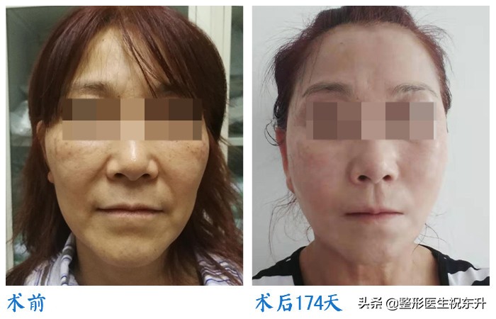 面部松弛严重只能做大拉皮手术吗,脸部皮肤松弛能做拉皮手术吗