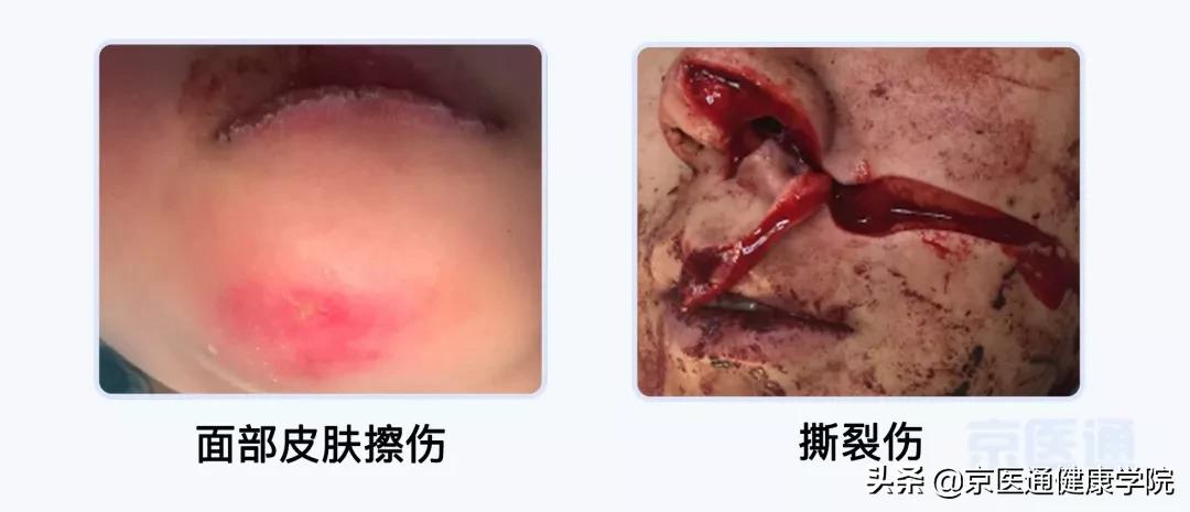 牙受伤后怎么保护,摔掉牙快速消肿方法