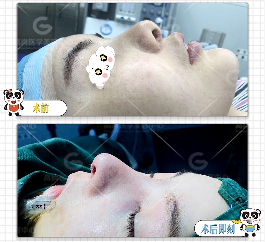 龚忠华：鼻部整形有讲究，你适合哪一种？