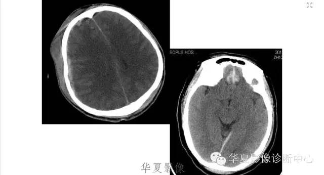 一文读懂颅内胆脂瘤,一文看懂背后的真相
