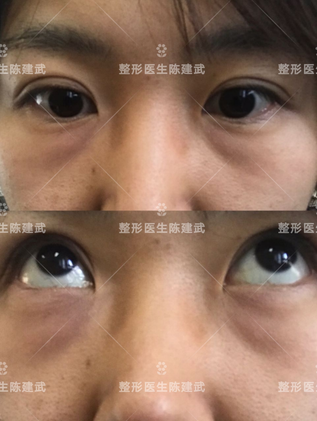 割眼袋是外切好还是内切好,割眼袋内切和外切有什么区别