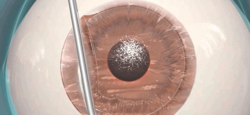 激光治疗近视什么原理,激光矫正是什么原理