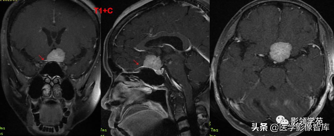 鞍区肿瘤做什么检查得出来,鞍区肿瘤的影像学鉴别