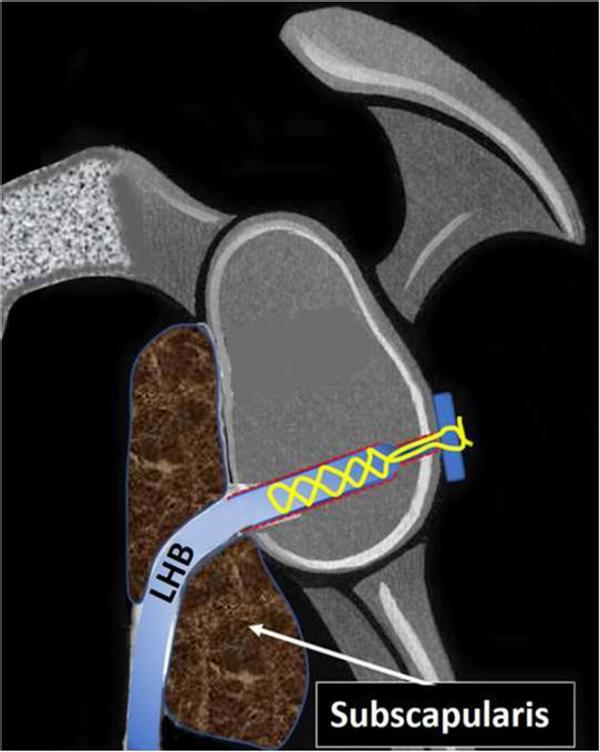 肩关节正斜位怎么治疗,怎么判断肩关节稳定不稳定