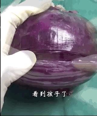 剖宫产简直痛到怀疑人生,剖宫产三次全过程