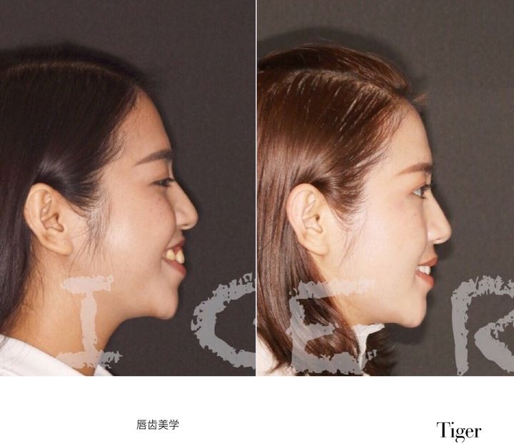 南京靠谱的牙齿矫正医院,南京省哪个医院牙齿矫正比较好