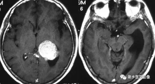 脑室影像学表现,脑室占位影像