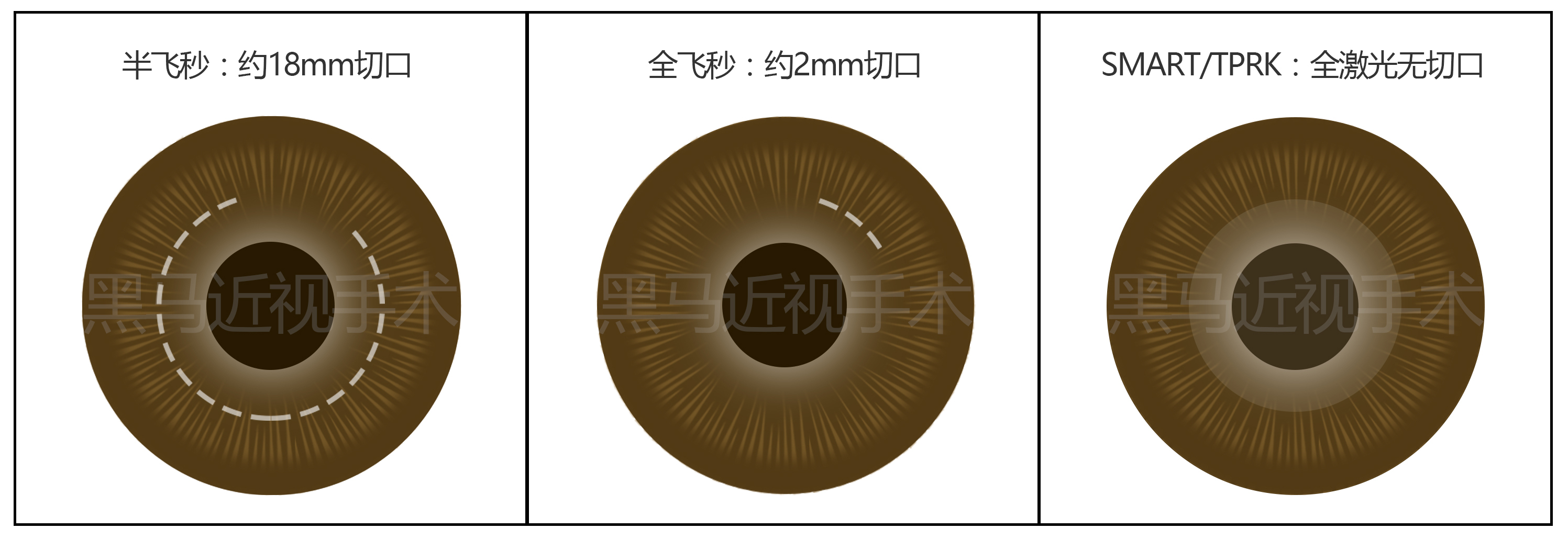 激光近视矫正手术有什么后遗症,激光治疗近视安全啊有没有后遗症
