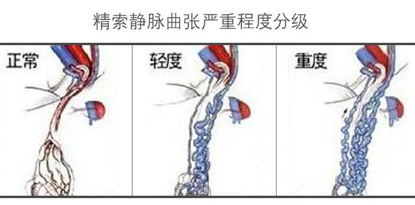 精索静脉曲张导致精子活力不足,静脉血液回流不畅怎么办