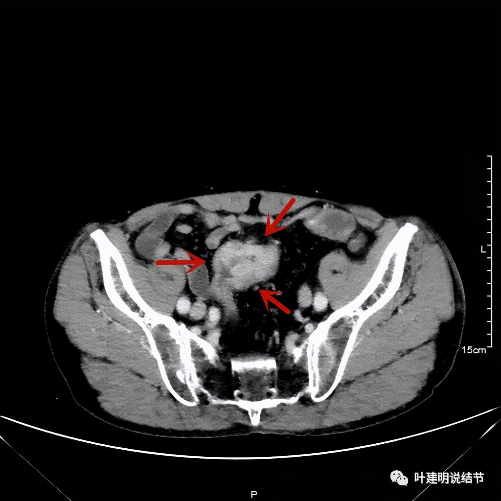 同时患结肠癌和直肠癌怎么办,同时查出了胃癌和肺癌怎么办
