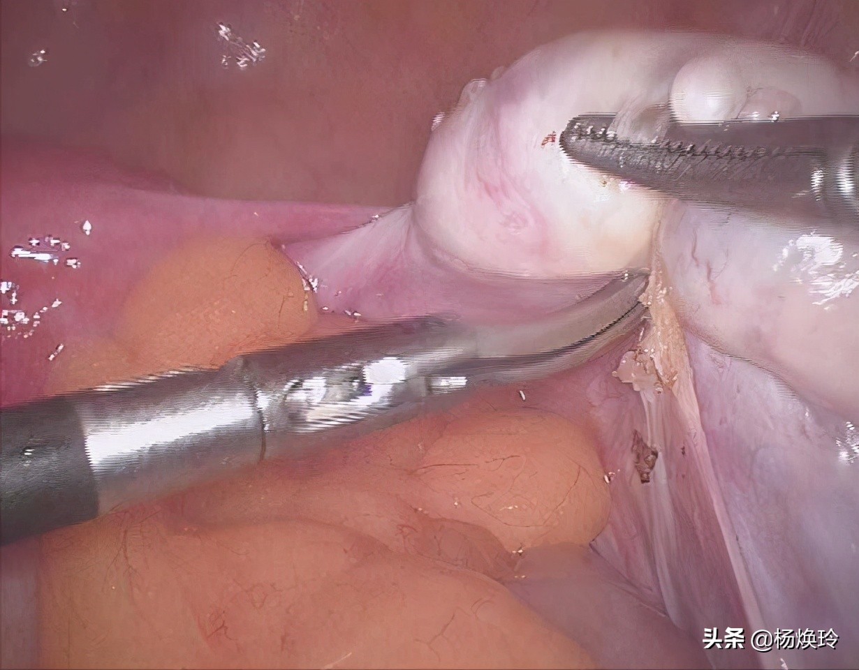 诊间日记-小李多囊,遗传惹的祸