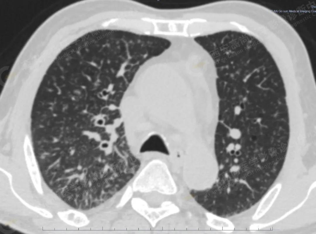petct检查报告肺结节考虑恶性肿瘤,30mm肺结节pet显示没有转移
