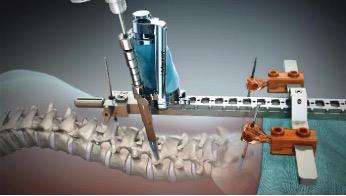 骨科步态机器人,骨科医疗机器人