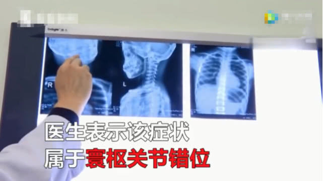 9岁男童因玩手机成“歪脖”，治疗时表姐忍不住露出笑容