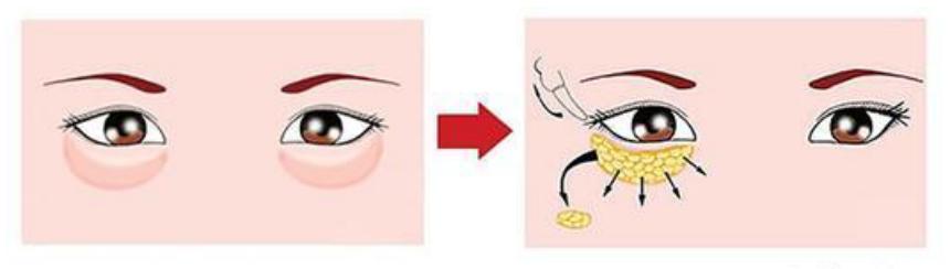 做了内切眼袋手术流泪会很刺痛,做完内切眼袋流眼泪有血