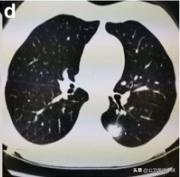 新型冠状病毒肺炎患者的肺,新型冠状病毒患者肺部体征
