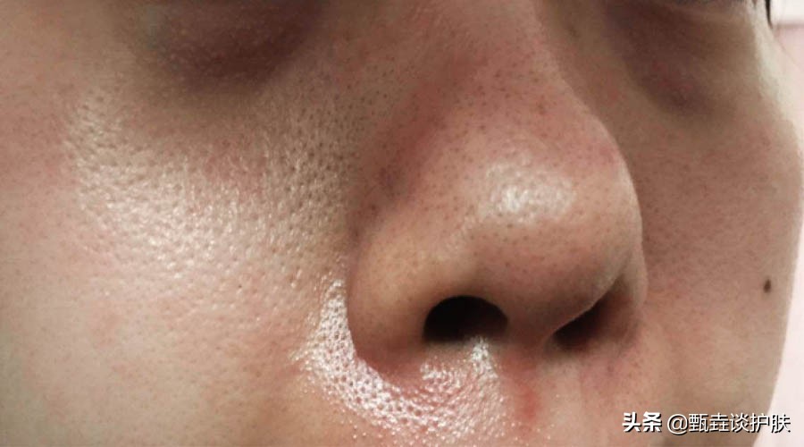 最好的黑头导出液,黑头导出液收缩毛孔排行榜第一名