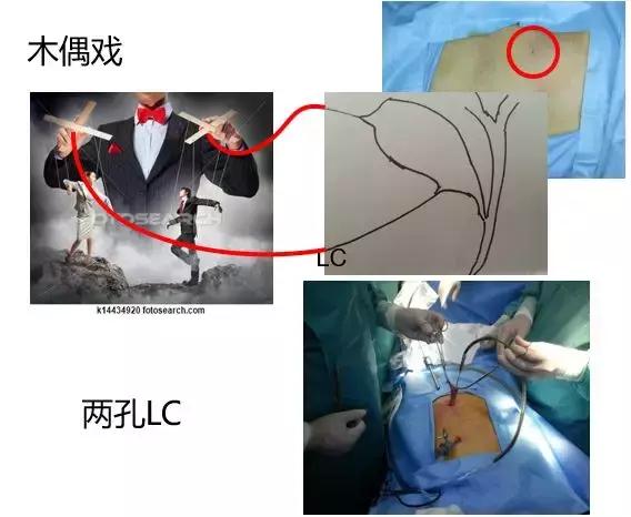 腹腔镜微创手术是高难度吗,腹腔镜技术在妇科的发展