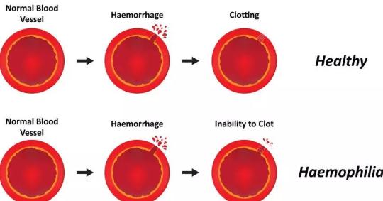 日本男子患罕见血友病舌头发黑肿胀,数度窒息心脏骤停险危及生命
