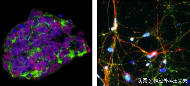 日本干细胞移植帕金森能治愈吗,北京干细胞移植治疗帕金森招募