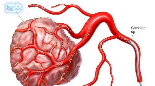 皮肌炎合并卵巢癌晚期怎么治疗,奥拉帕利治疗卵巢癌晚期效果好吗